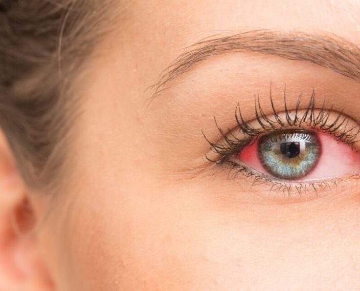 Blepharitis After BlephEX Treatment