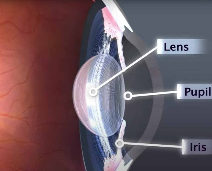CATARACT SURGERY image and video