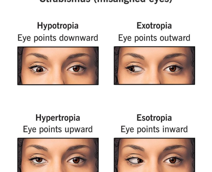 CROSS EYES IMAGE