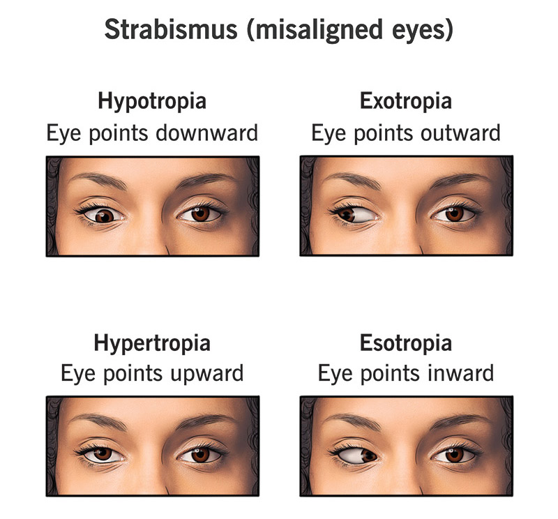 CROSS EYES IMAGE