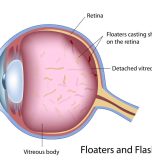 eye floaters headache
