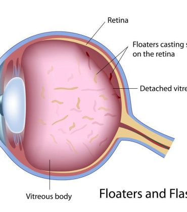 eye floaters headache