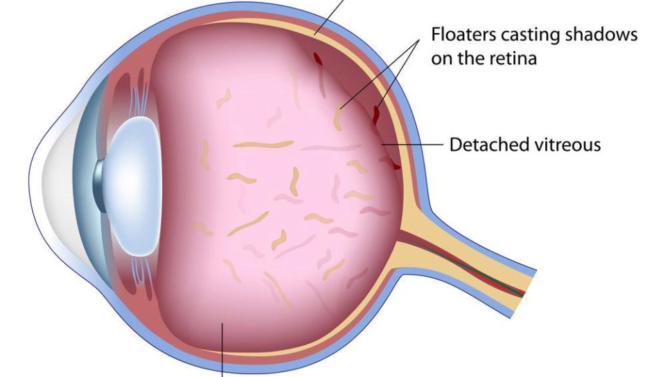 eye floaters headache