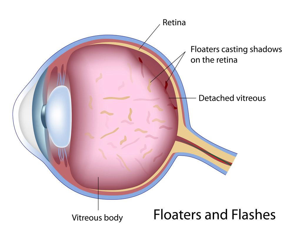 eye floaters headache
