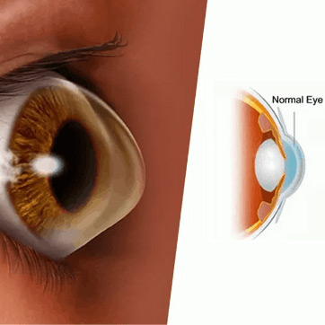 Keratoconus