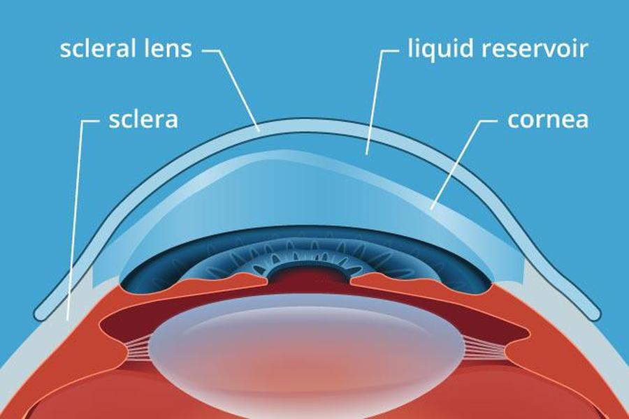Scleral Lenses image