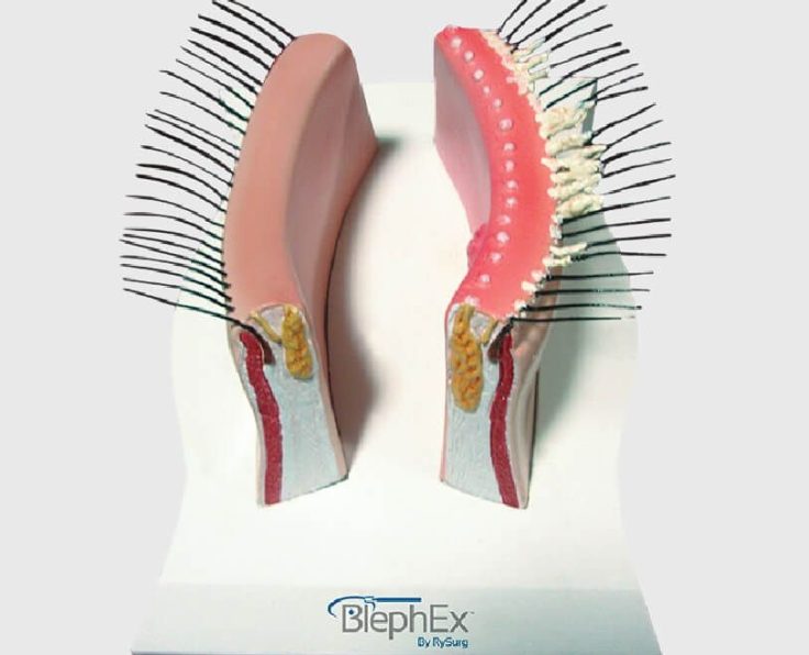 What is BlephEx