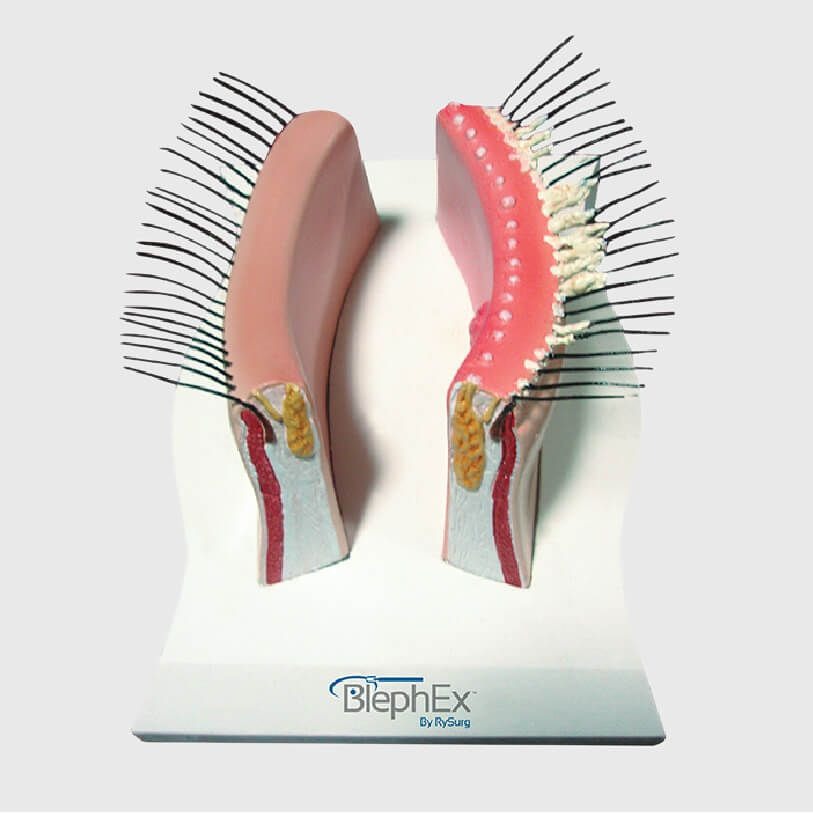 What is BlephEx