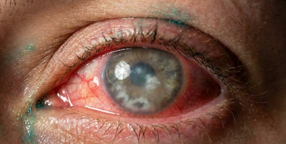 chemical burn in the eye