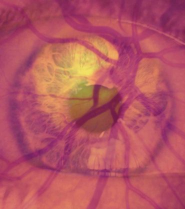 diabetic eye treatments