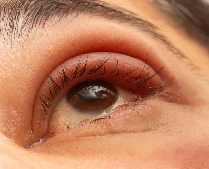 dry eye syndrome
