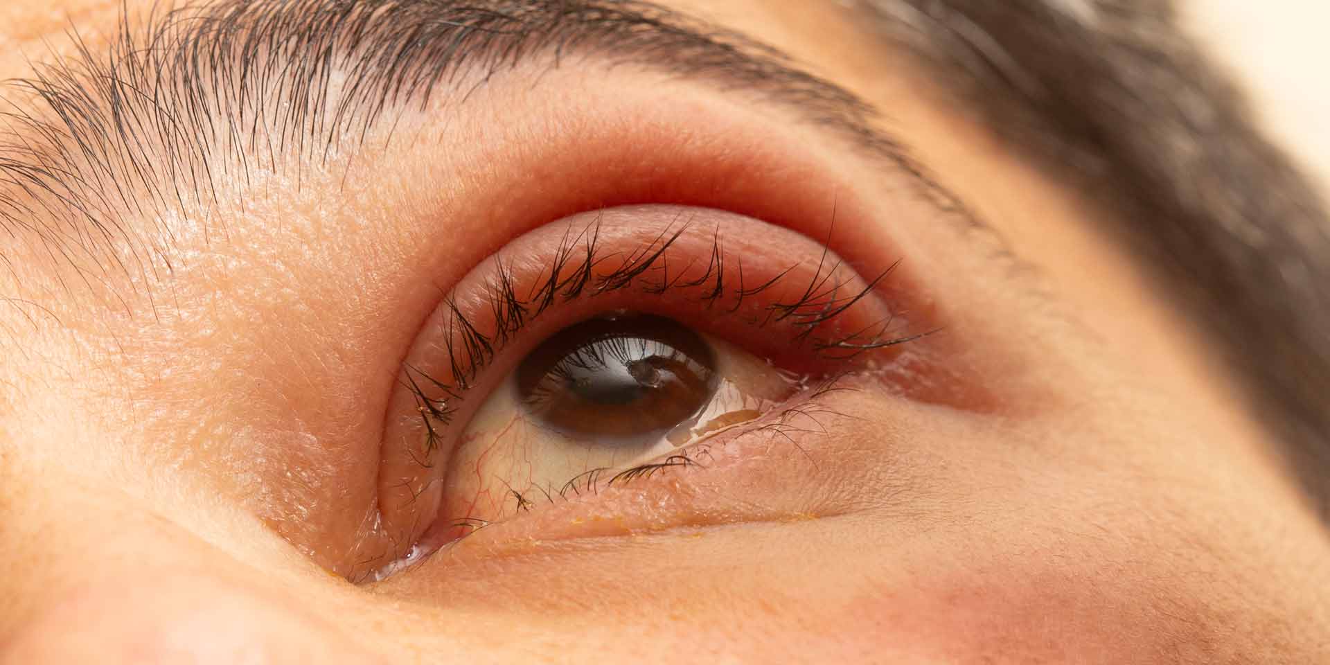 dry eye syndrome