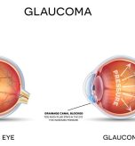 glaucoma symptoms