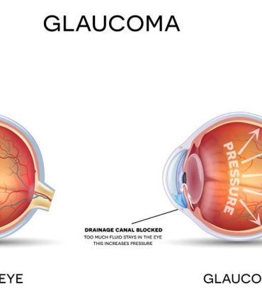 glaucoma symptoms
