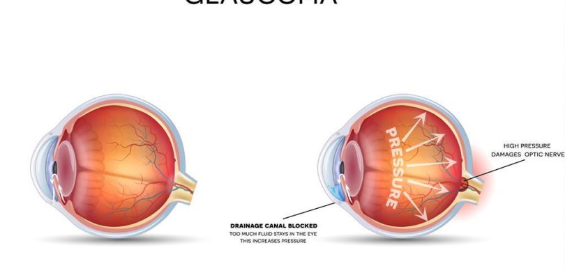 glaucoma symptoms