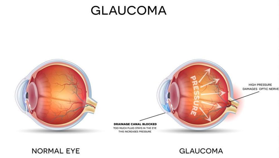 glaucoma symptoms