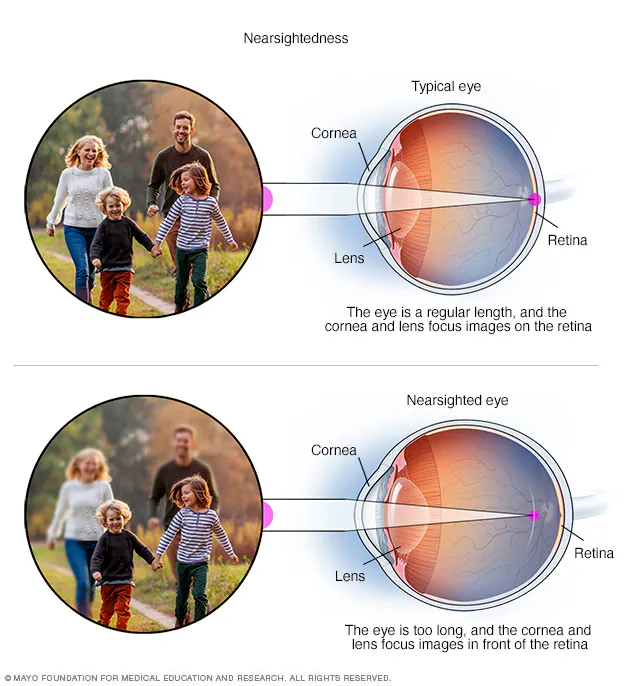 Myopia in children image