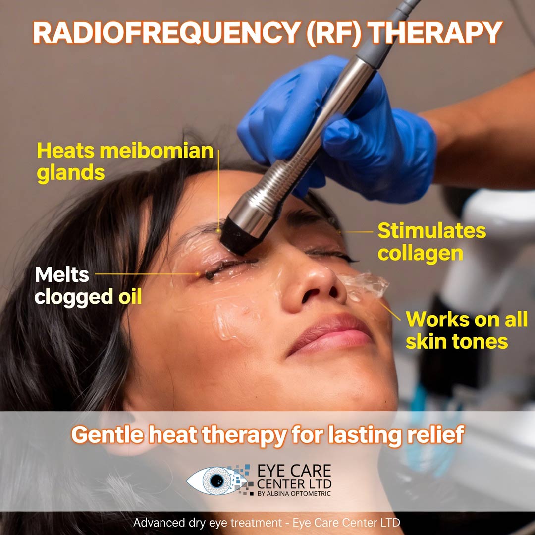 Radiofrequency therapy for meibomian gland dysfunction and chronic dry eye