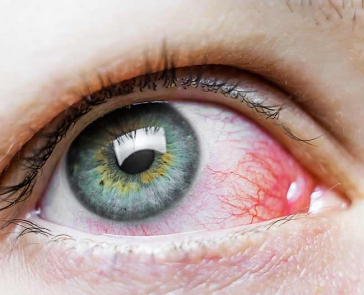 red eye treatment options near addison, IL red eye treatment options near addison, IL