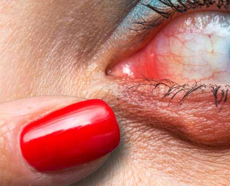 stye chalazion treatment willowbrook IL